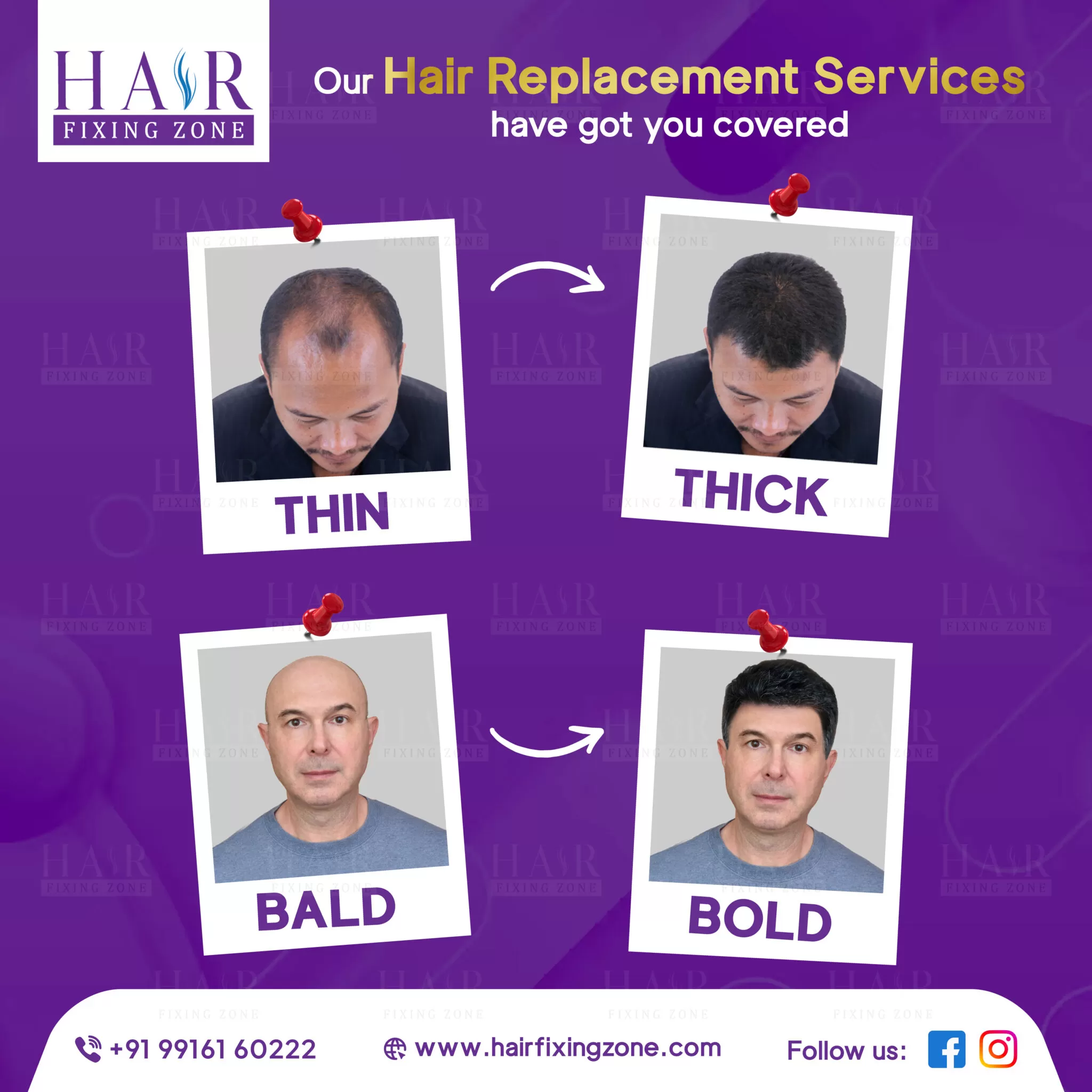 Hair Replacement Services