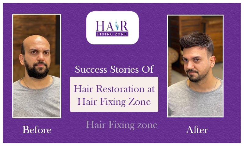 Success Stories of Hair Restoration at Hair Fixing Zone